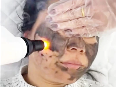 Adakah kulit kelihatan lebih teruk selepas laser?